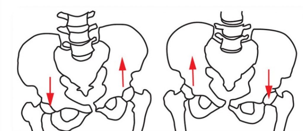 how-to-fix-a-lateral-pelvic-tilt-good-posture-hq