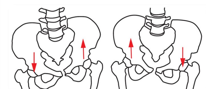 Lateral Pelvic Tilt