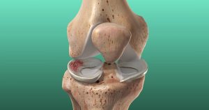 what causes repeated meniscus tear